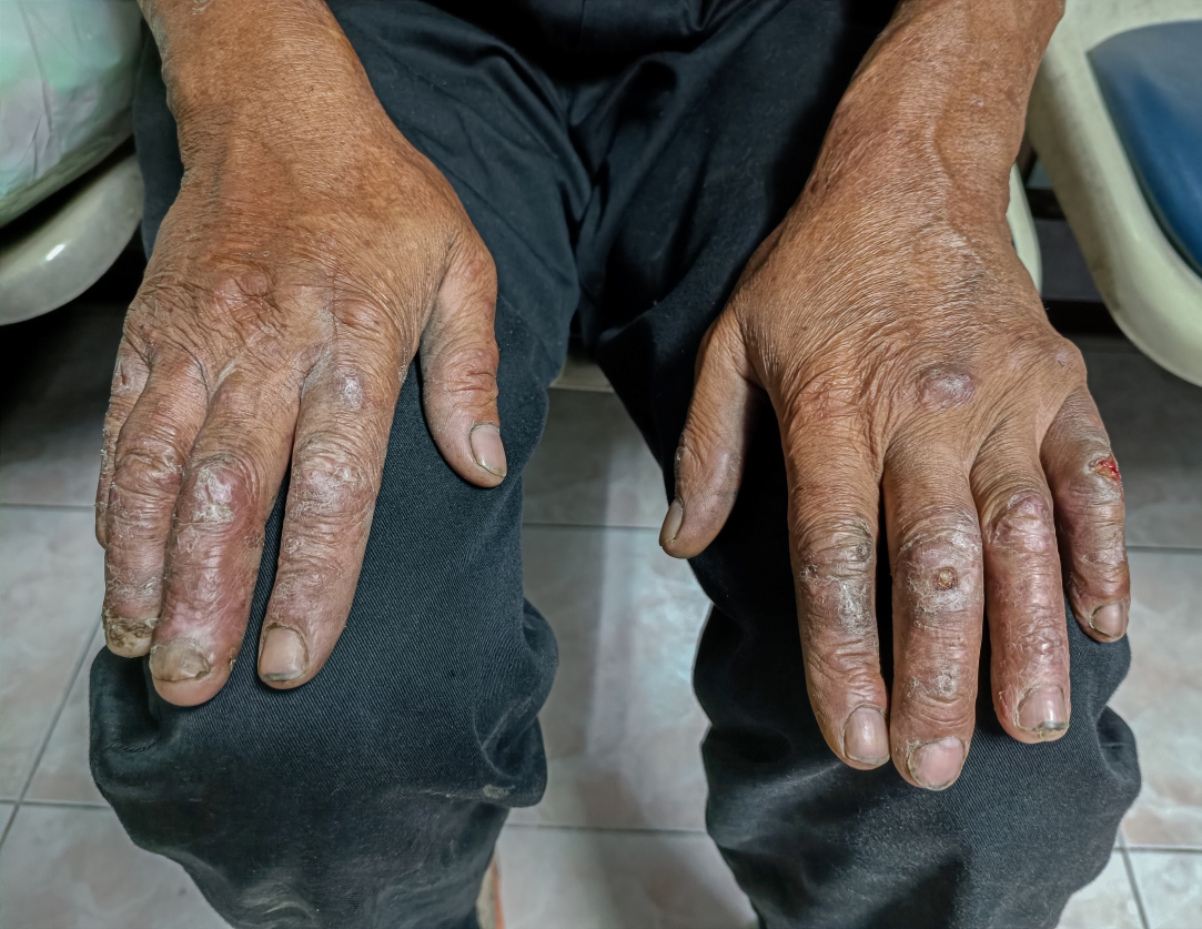 Hands of a person with leprosy (Photo: AdobeStock/Swiss TPH)